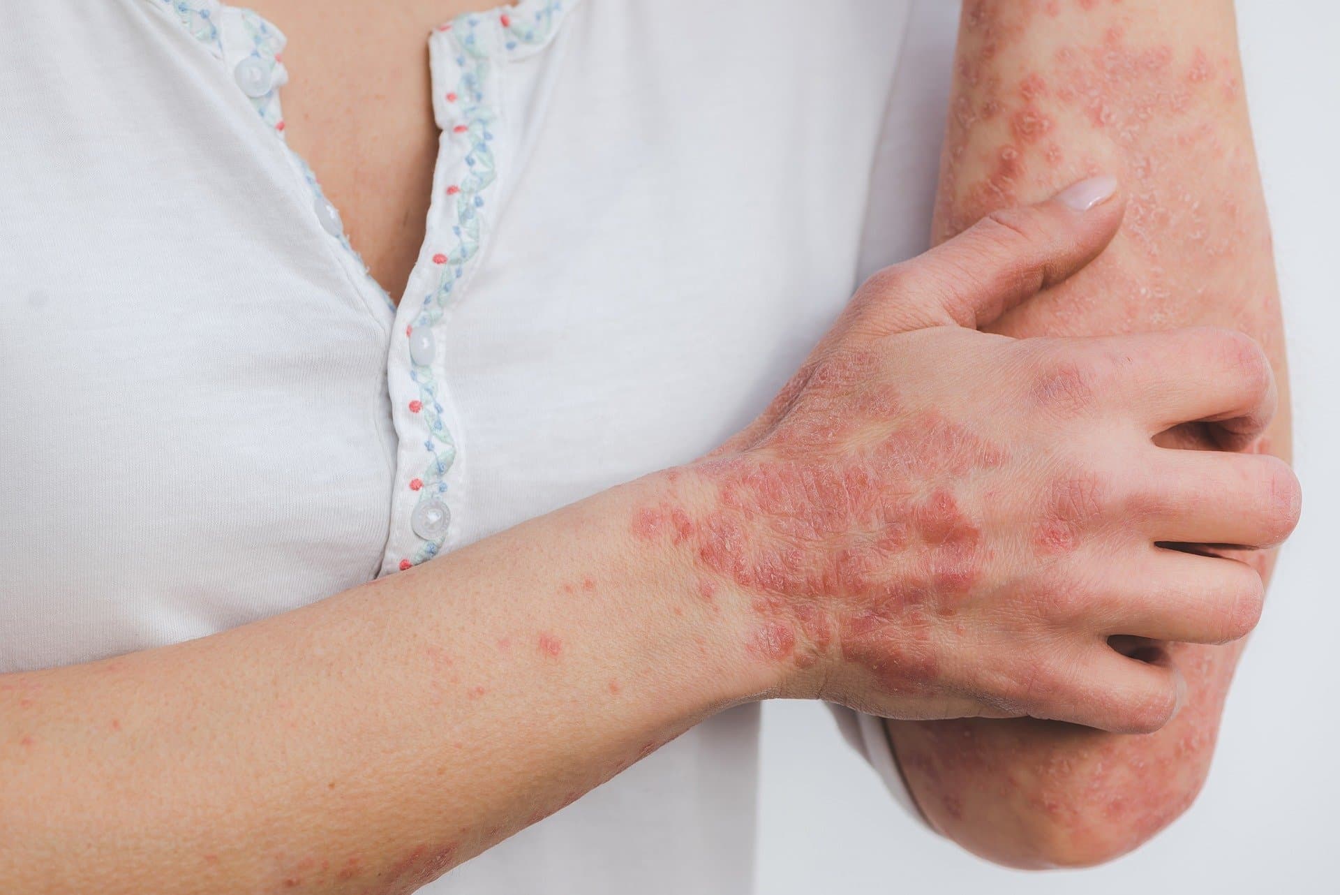 Image blog - psoriasis-et-cryothérapie-en-cabine
