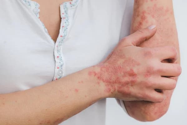 Image blog - psoriasis-et-cryothérapie-en-cabine